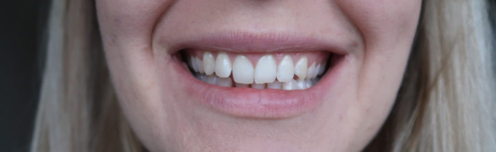clear braces invisible aligners